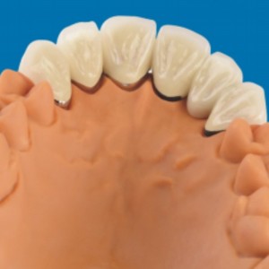 Metal-dentes de porcelana